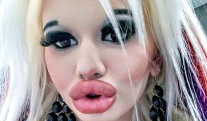 Craving for the beautiful: Bulgarian student enlarges her lips and can't stop