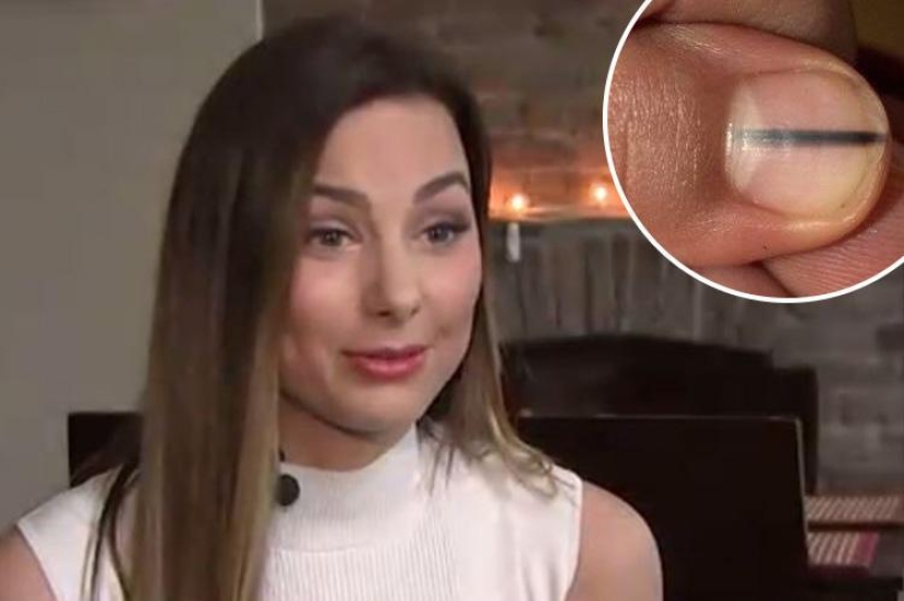 Deadly manicure: the beauty queen was diagnosed with cancer after nail extensions