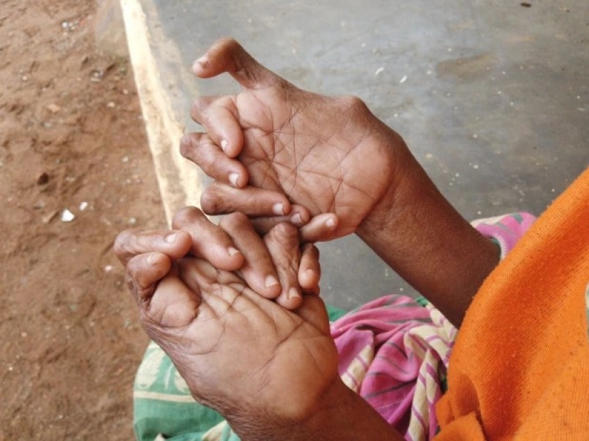Dedos con abanico: una mujer con 31 dedos entró en el Libro Guinness de los Récords