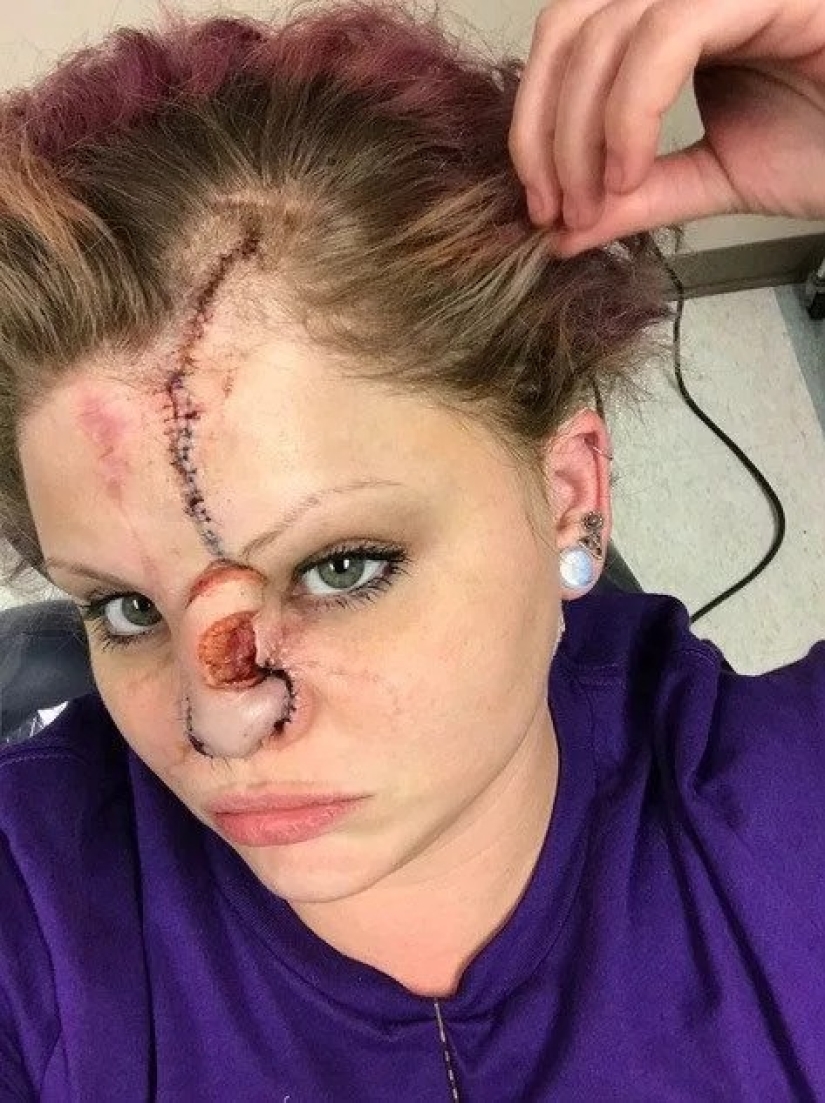 Disfigured love: a pit bull bit off a girl's nose, but she forgave him and continues to cuddle with dogs