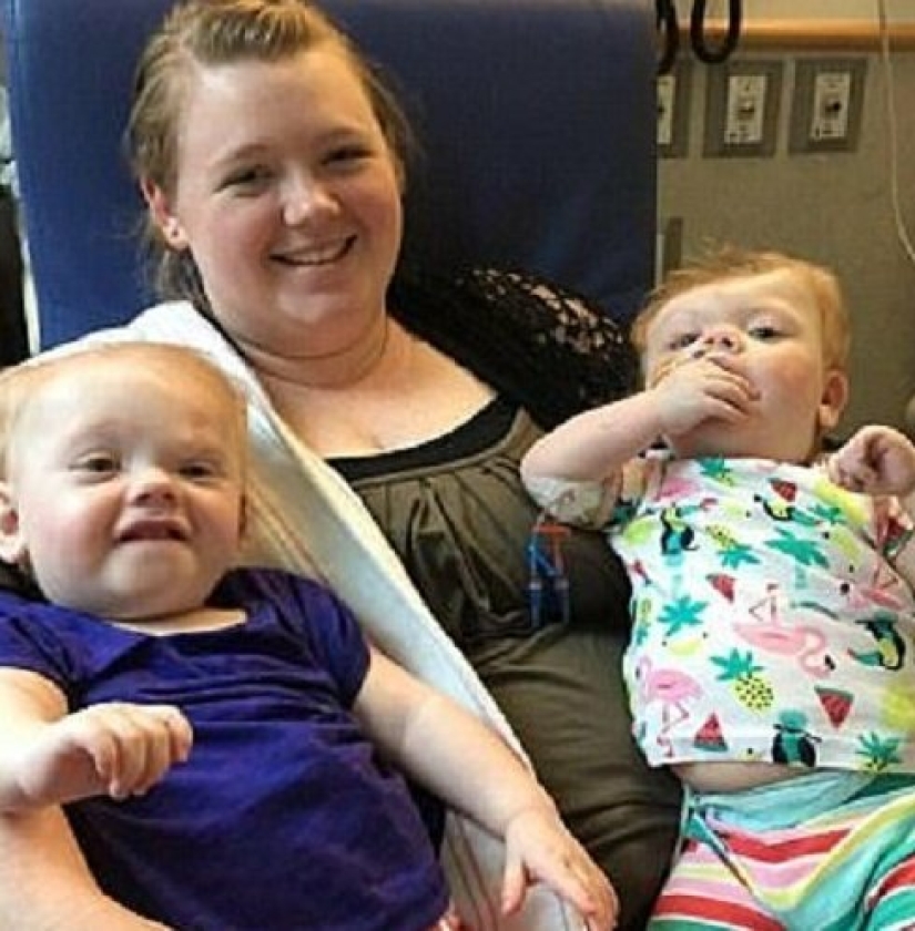 El derecho a la vida: gemelos siameses de 1,5 años, nacidos con la cabeza fusionada, se recuperaron de una operación complicada y se regocijan todos los días