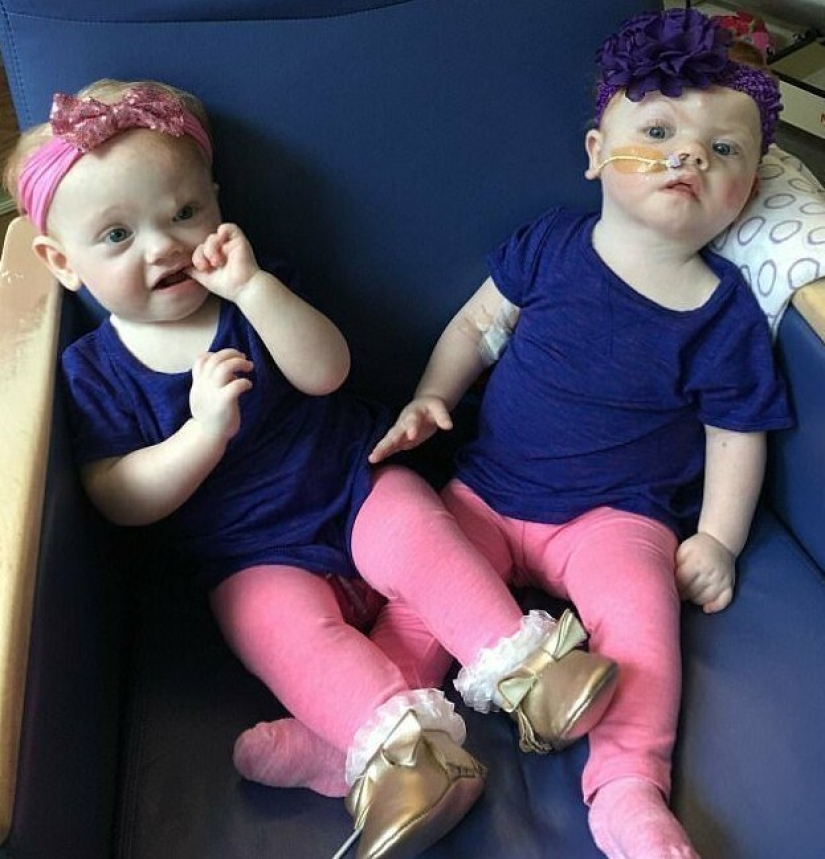 El derecho a la vida: gemelos siameses de 1,5 años, nacidos con la cabeza fusionada, se recuperaron de una operación complicada y se regocijan todos los días