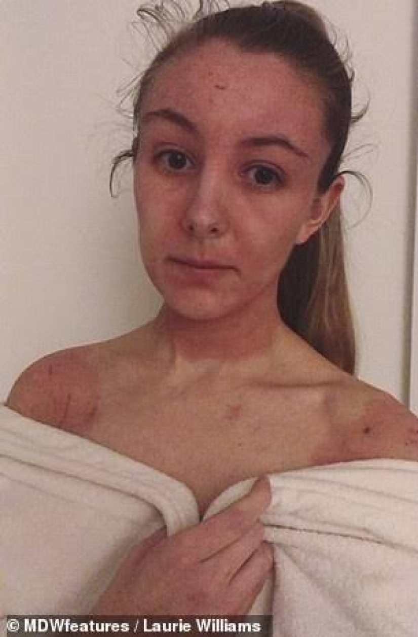 El resultado es evidente: una mujer se deshizo de la horrible eczema, lanzando crema con esteroides y convertirse en un vegetariano