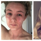 El resultado es evidente: una mujer se deshizo de la horrible eczema, lanzando crema con esteroides y convertirse en un vegetariano