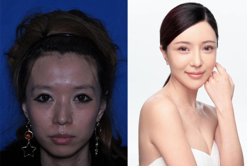 Estándares de belleza: mujeres chinas después de la cirugía plástica