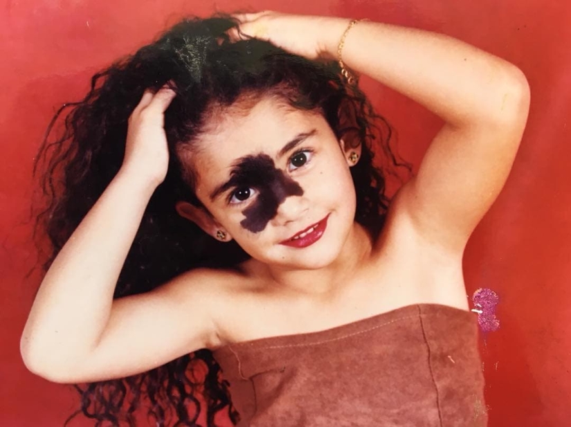 Everyone mocked this girl because of her birthmark, and she took and became a model