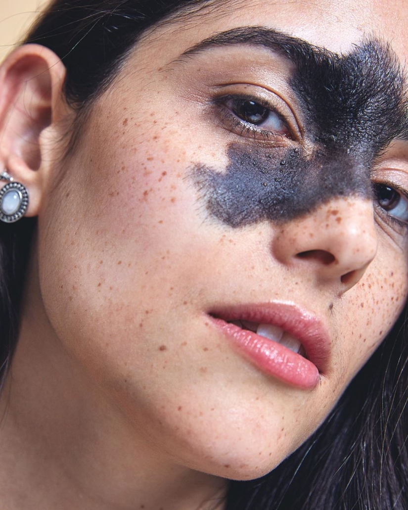 Everyone mocked this girl because of her birthmark, and she took and became a model