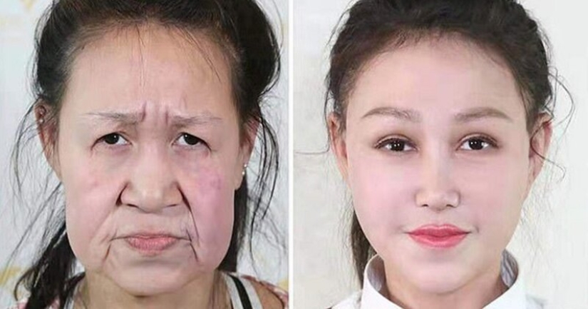 From grandmother to girl: a 15-year-old Chinese woman with an old woman's face underwent surgery