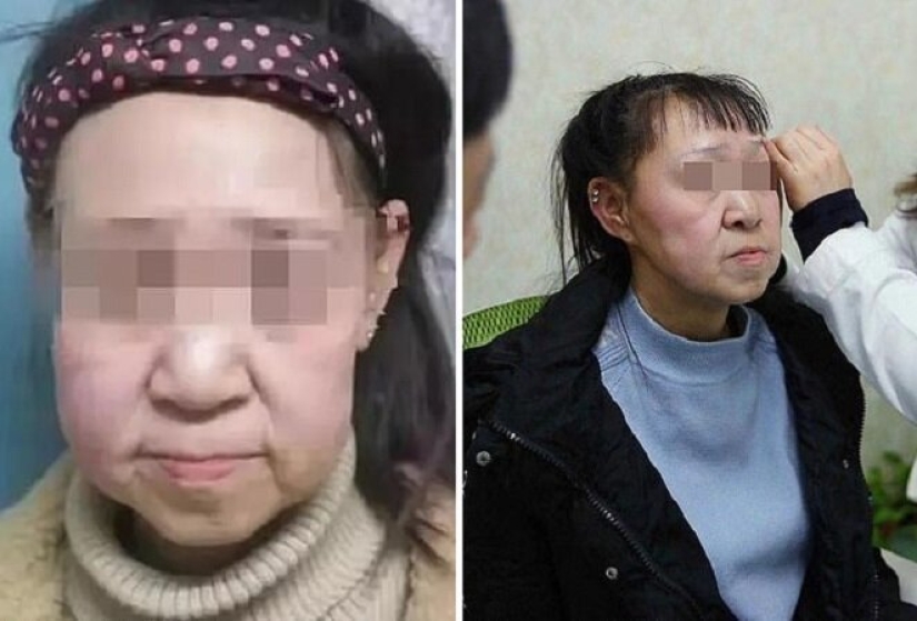 From grandmother to girl: a 15-year-old Chinese woman with an old woman's face underwent surgery