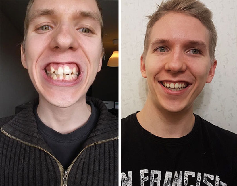 Here's how radically braces change a smile and life