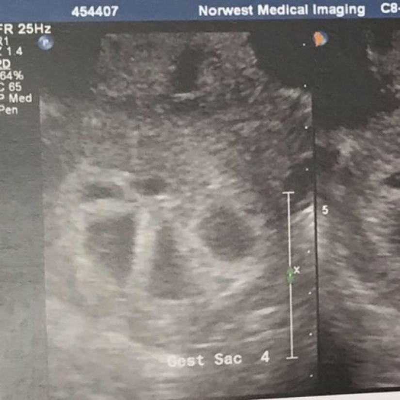 Here's what a woman pregnant with quintuplets looks like