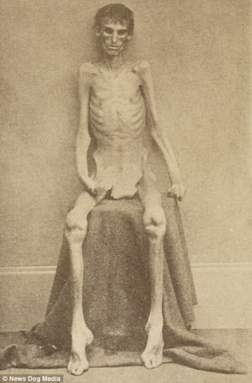Horrifying photos of victims of the bloodiest war in US history