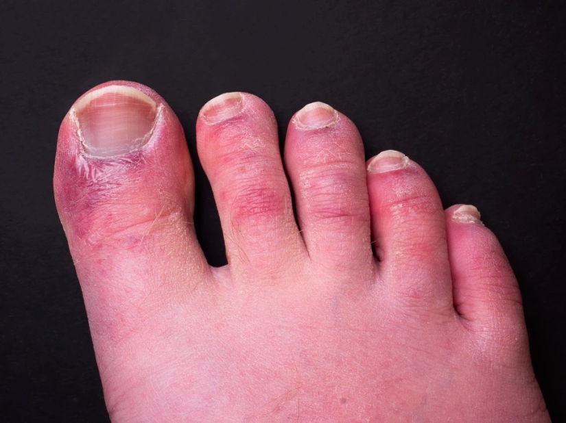 How the feet display the state of health — 8 signals about serious diseases