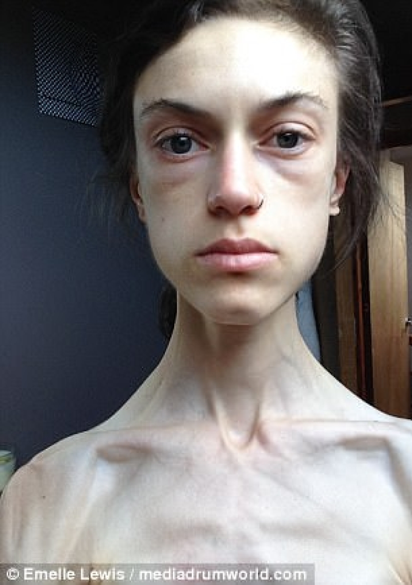 "Instagram me salvó la vida": una mujer anoréxica quería vivir gracias a las fotos de niñas que derrotaron la enfermedad