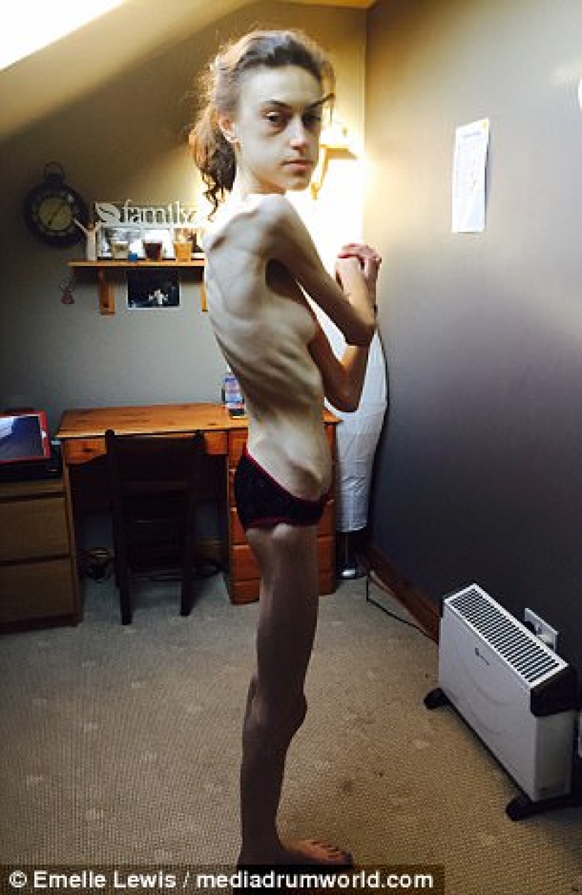 "Instagram saved my life": anorexic woman wanted to live thanks to photos of girls who defeated the disease
