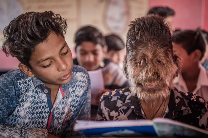 Kind and fluffy: A 13-year-old boy from India suffers from "werewolf syndrome"