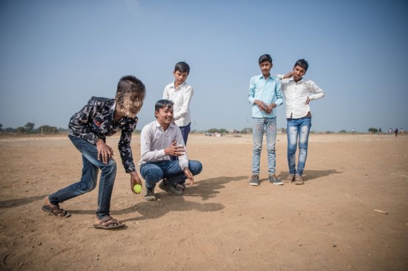 Kind and fluffy: A 13-year-old boy from India suffers from "werewolf syndrome"