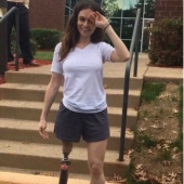"La amputación ya es mejor": una niña perdió una pierna a los 11 años, se convirtió en modelo y ahora inspira a otros