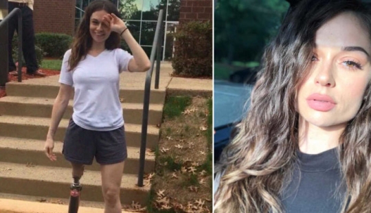 "La amputación ya es mejor": una niña perdió una pierna a los 11 años, se convirtió en modelo y ahora inspira a otros "La amputación ya es mejor": una niña perdió una pierna a los 11 años, se convirtió en modelo y ahora inspira a otros