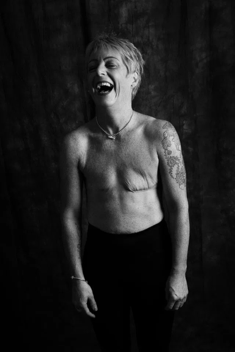La verdad desnuda: Pacientes valientes se enfrentan al cáncer mostrando cicatrices en el conmovedor proyecto fotográfico de Ami Barwell