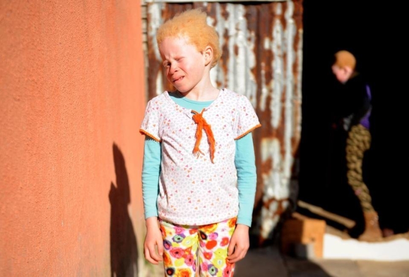 Los albinos africanos no ocultan sus miedos