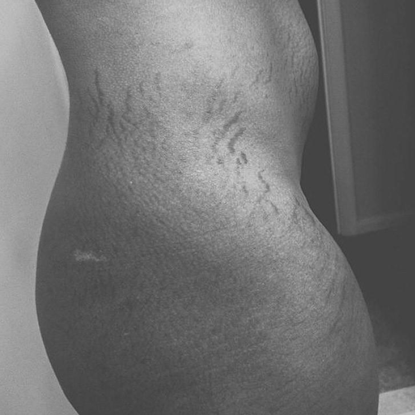 Love your stretch marks