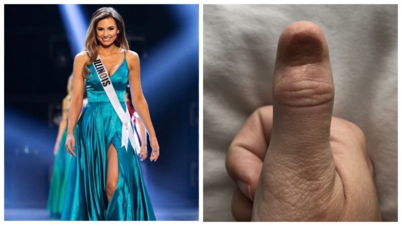 Manicura mortal: la reina de belleza fue diagnosticada con cáncer después de las extensiones de uñas