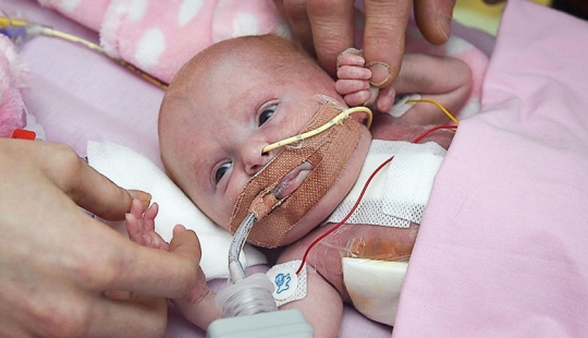 Médicos británicos salvaron a una niña que nació con el corazón fuera