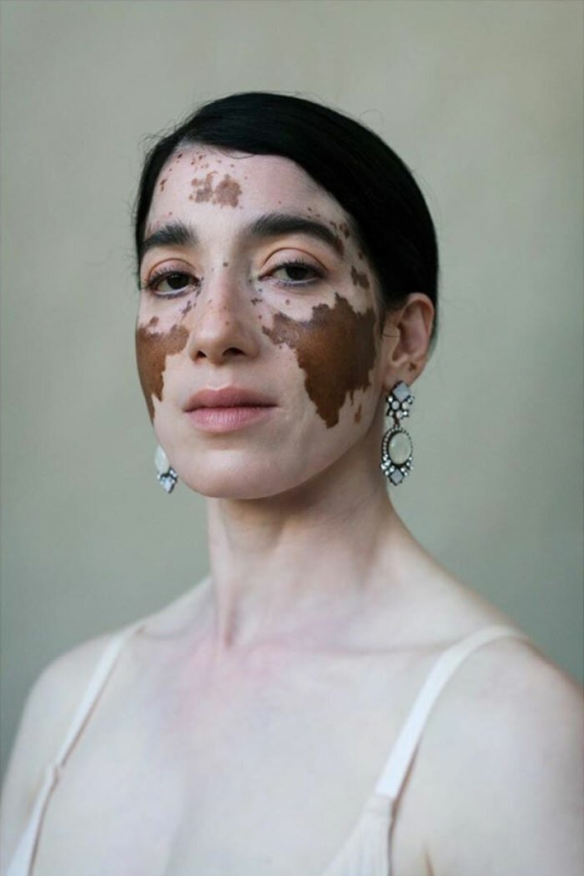 Models with vitiligo: beautiful and amazing