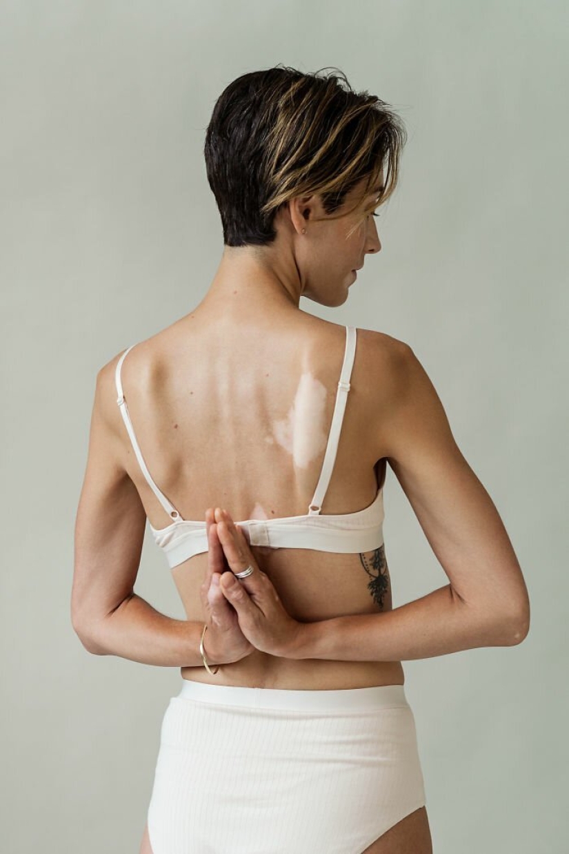 Models with vitiligo: beautiful and amazing