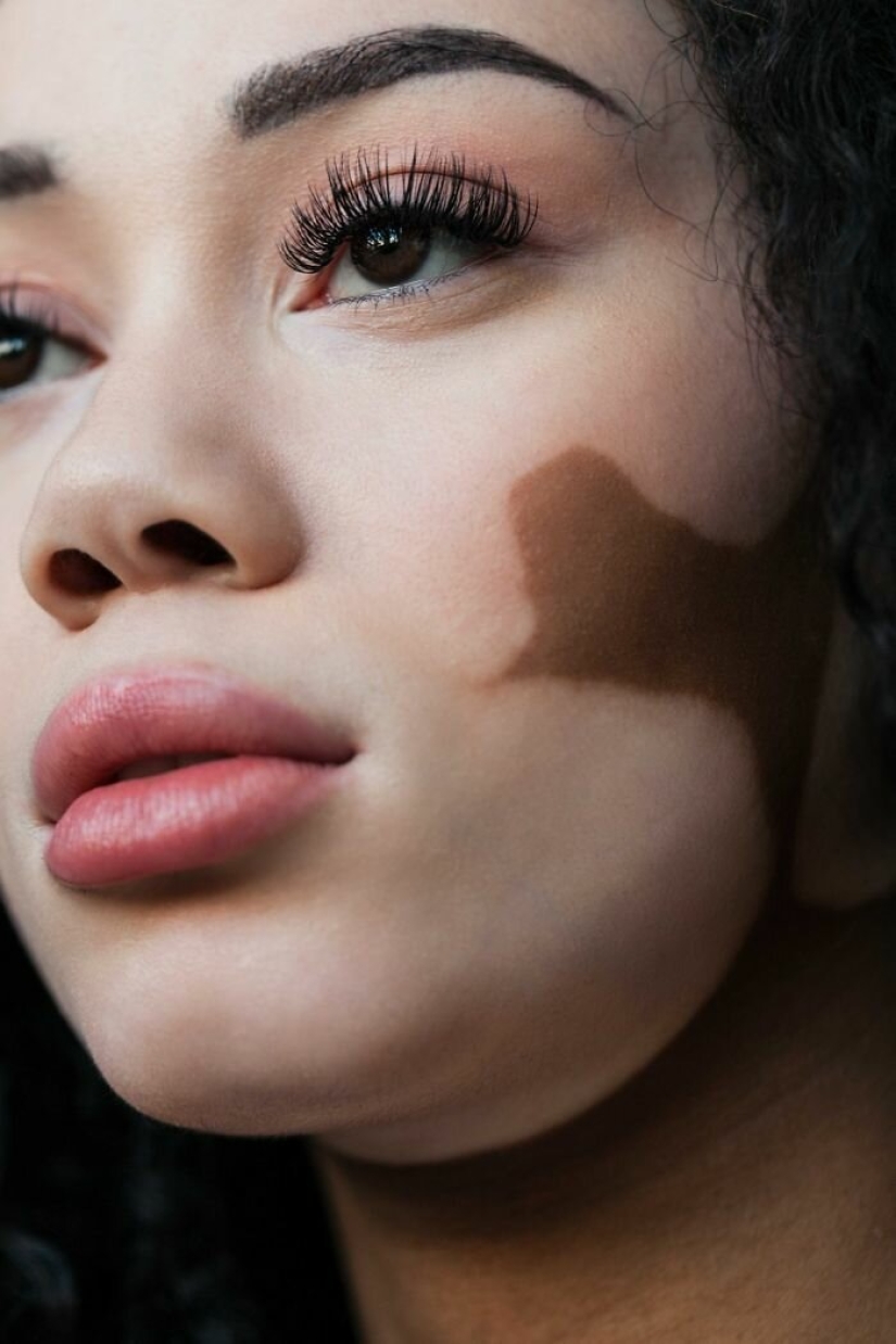 Models with vitiligo: beautiful and amazing