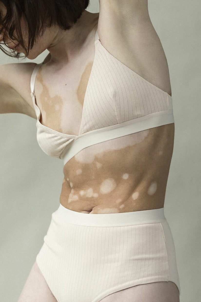 Models with vitiligo: beautiful and amazing