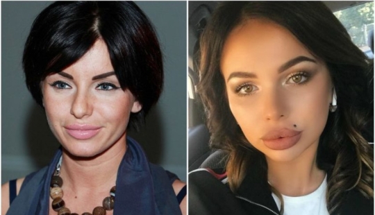 "No labios, sino albóndigas": 8 estrellas rusas que se excedieron en la ampliación