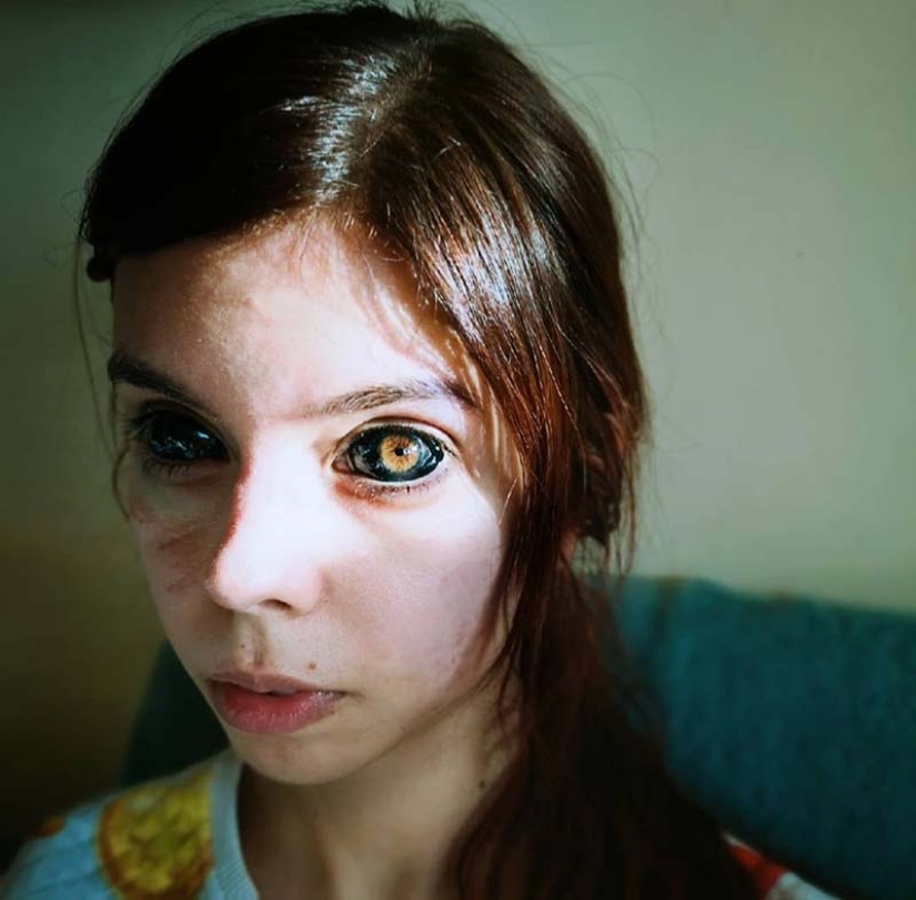 Ojos negros: modelo de Polonia se quedó ciego después de tatuarse los ojos