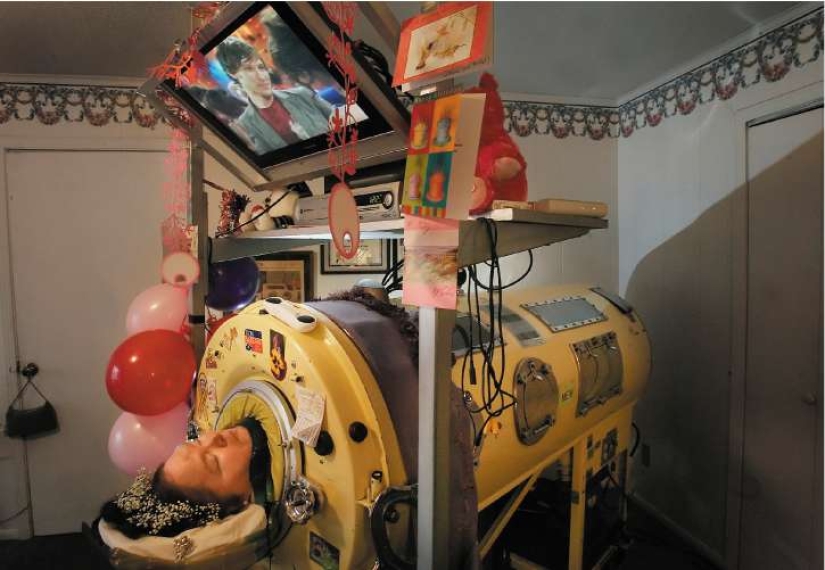 Prisoners of the "Iron lung": how to rescue victims of polio, have forgotten how to breathe