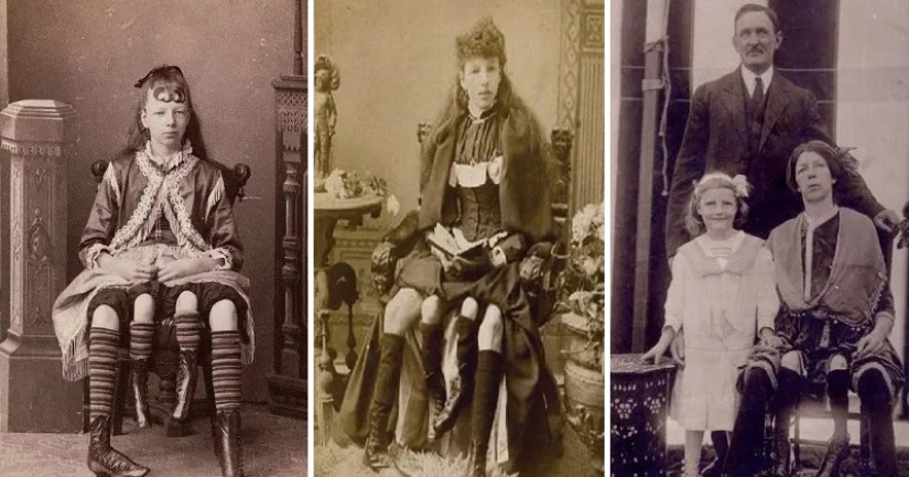 The Amazing story of Josephine Myrtle Corbin, a four—legged woman from Texas