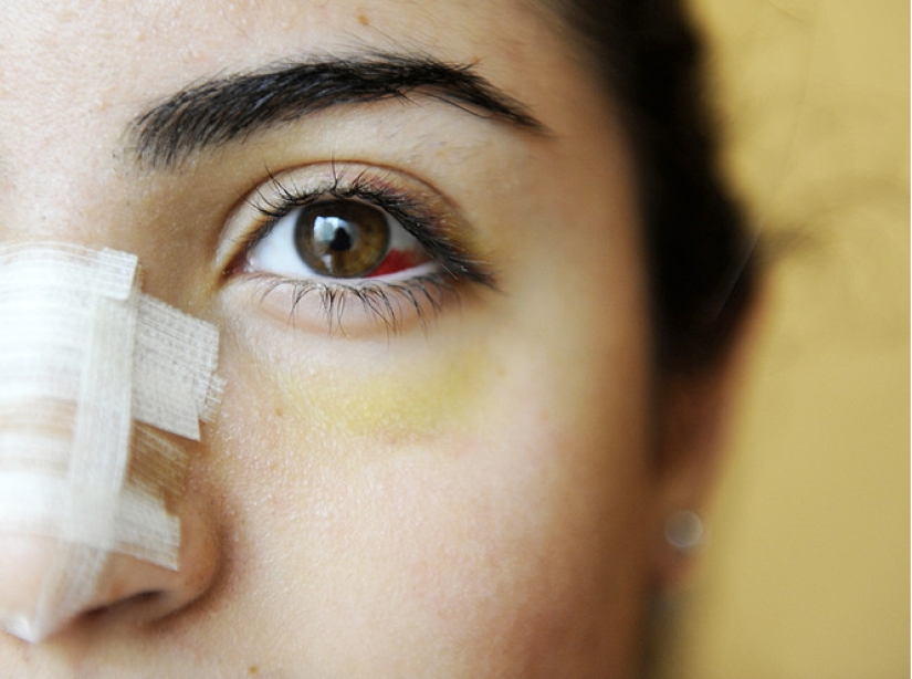 The cult of beauty: why all teenage girls in Lebanon have rhinoplasty