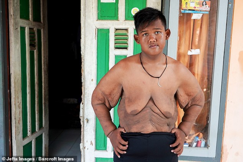 The fattest boy in the world, who weighed 192 kg at the age of 10, lost more than twice as much weight