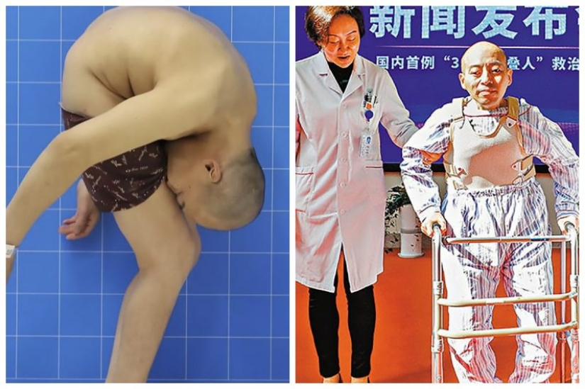 The man lived 28 years folded in half due to a rare disease