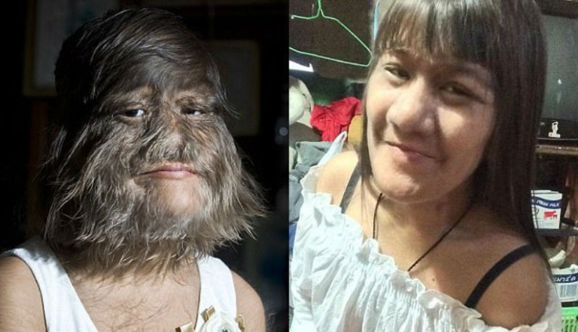 "The most hairy girl in the world" got married and started shaving her face