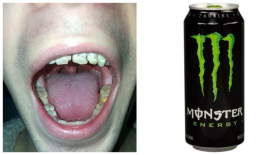 The power engineer who destroyed teeth and life: the 21-year-old guy lost his smile and dreams, regularly drinking an invigorating drink