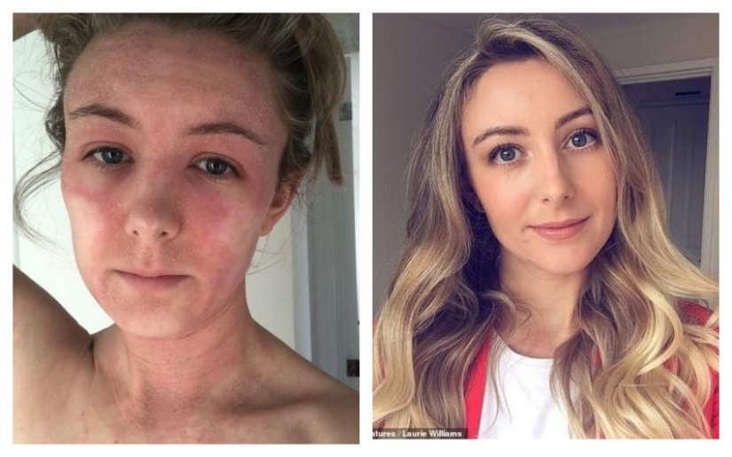 The result is evident: a woman got rid of the horrible eczema, throwing cream on steroids and becoming a vegetarian