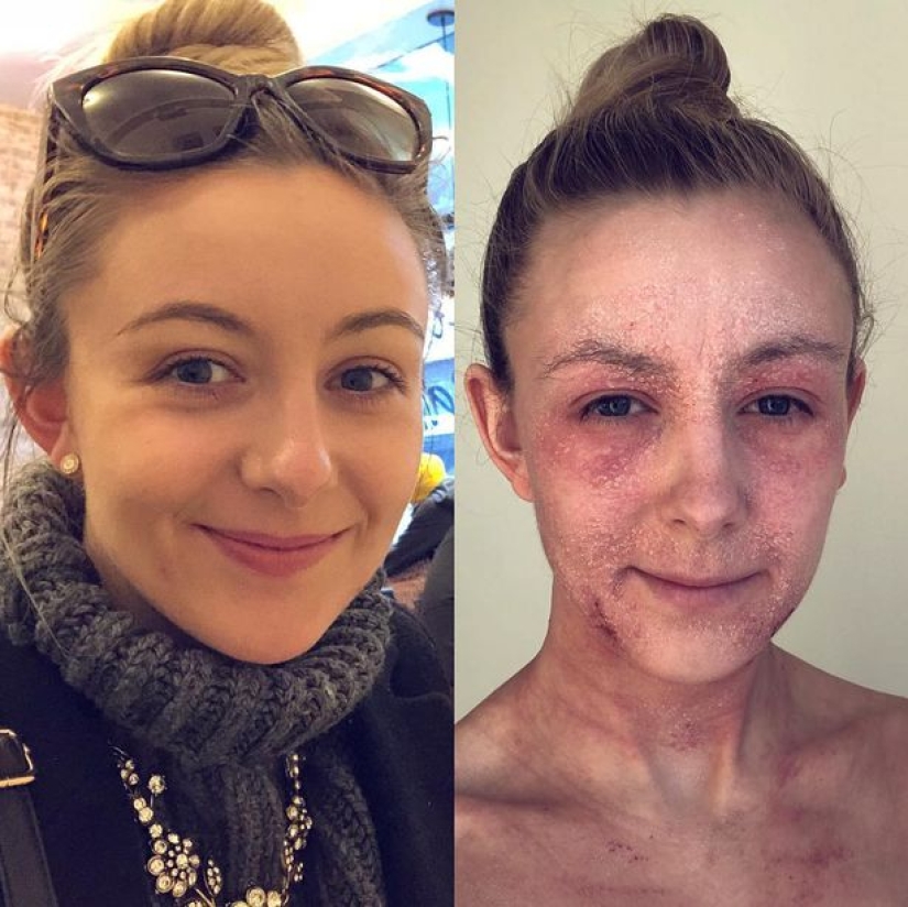 The result is evident: a woman got rid of the horrible eczema, throwing cream on steroids and becoming a vegetarian