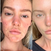 The result is obvious: the Sports Illustrated model got rid of acne, thanks to nutrition and meditation