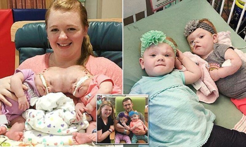 The right to life: 1.5-year-old Siamese twins, born with fused heads, recovered after a complicated operation and rejoice every day