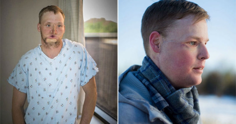 Un suicidio fallido le trasplantó la cara y comenzó una nueva vida para él