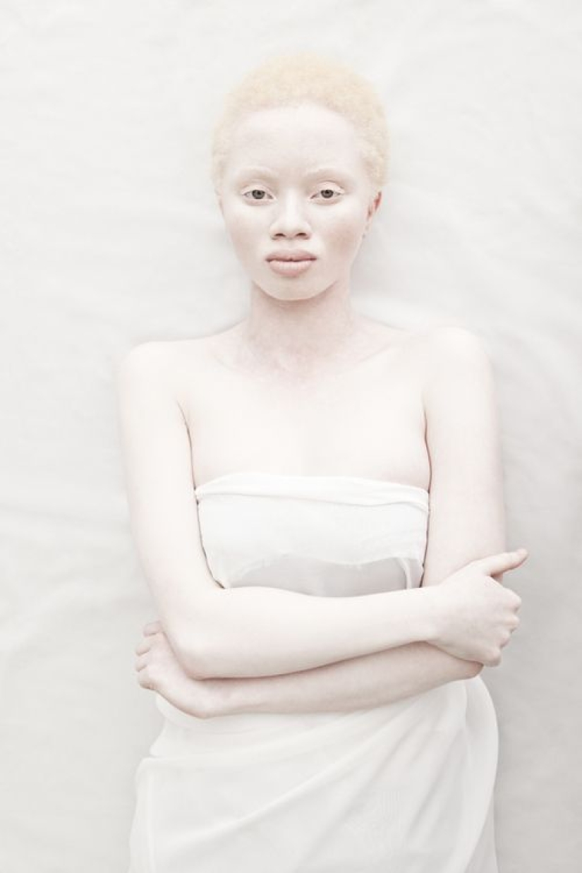 What do albinos of different nationalities and races look like