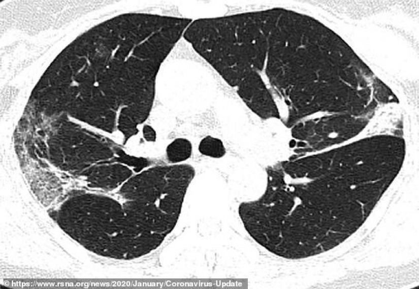 What do the lungs affected by coronavirus look like