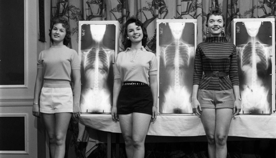 X-ray, plumb line and scales: how to choose "Miss correct posture" in the 50s X-ray, plumb line and scales: how to choose "Miss correct posture" in the 50s