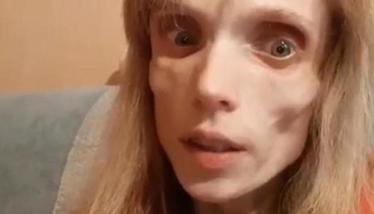 "You could play a corpse in a horror movie": doctor humiliated girl with anorexia